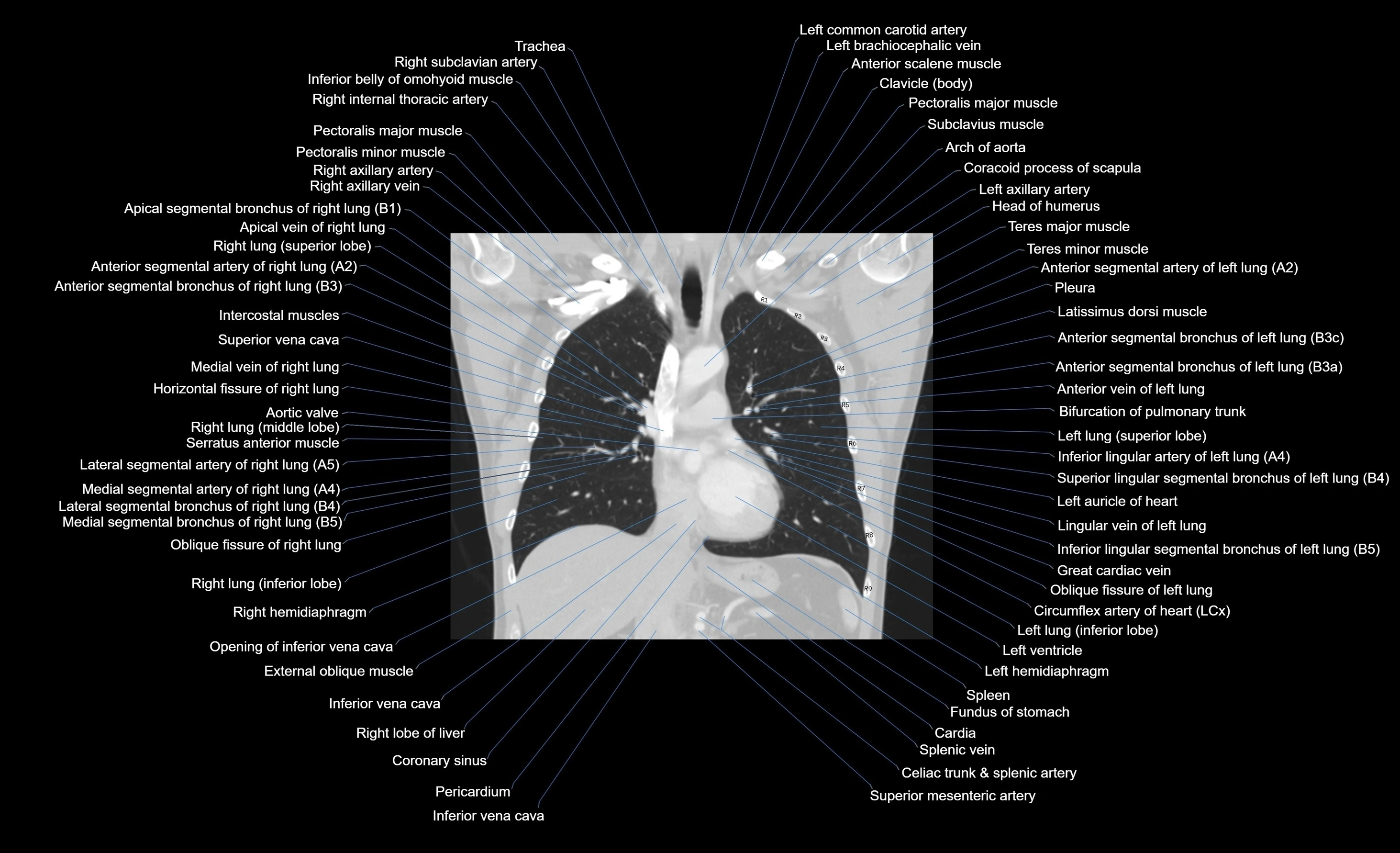 CT chest (thorax) lung window window labelled coronal cross sectional anatomy radiology image-00066.webp